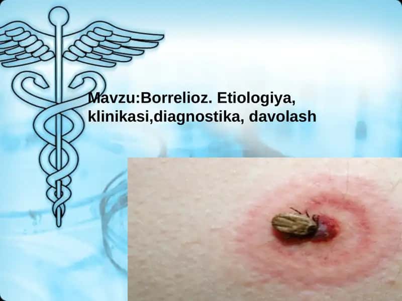 Borreliozlar