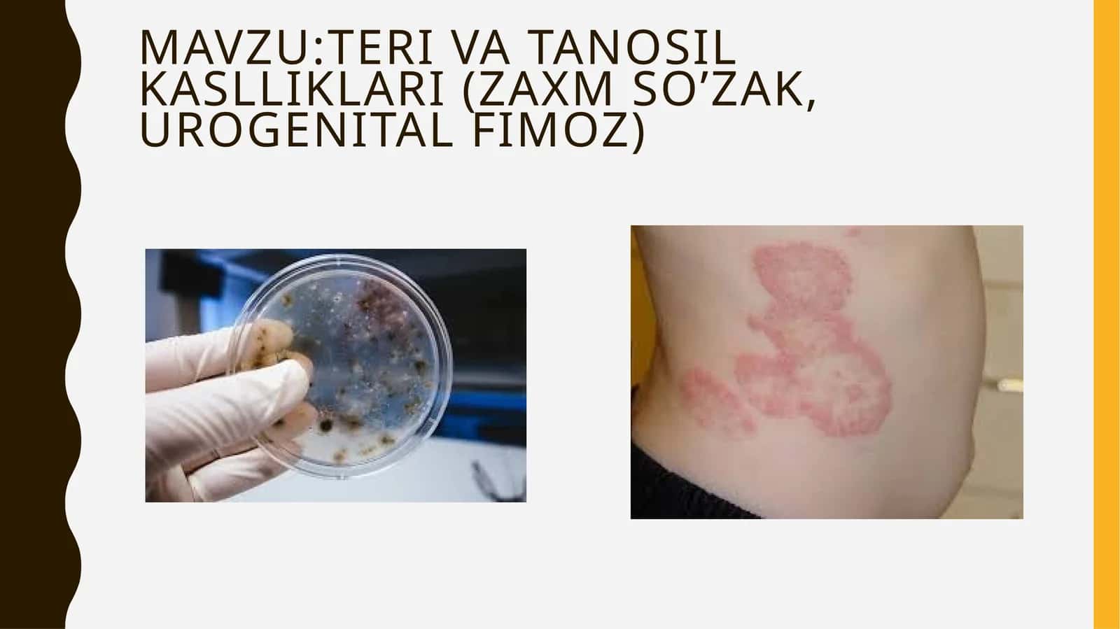 TERI VA TANOSIL KASLLIKLARI (ZaxMSO’ZAK, UROGENITAL FIMOZ)