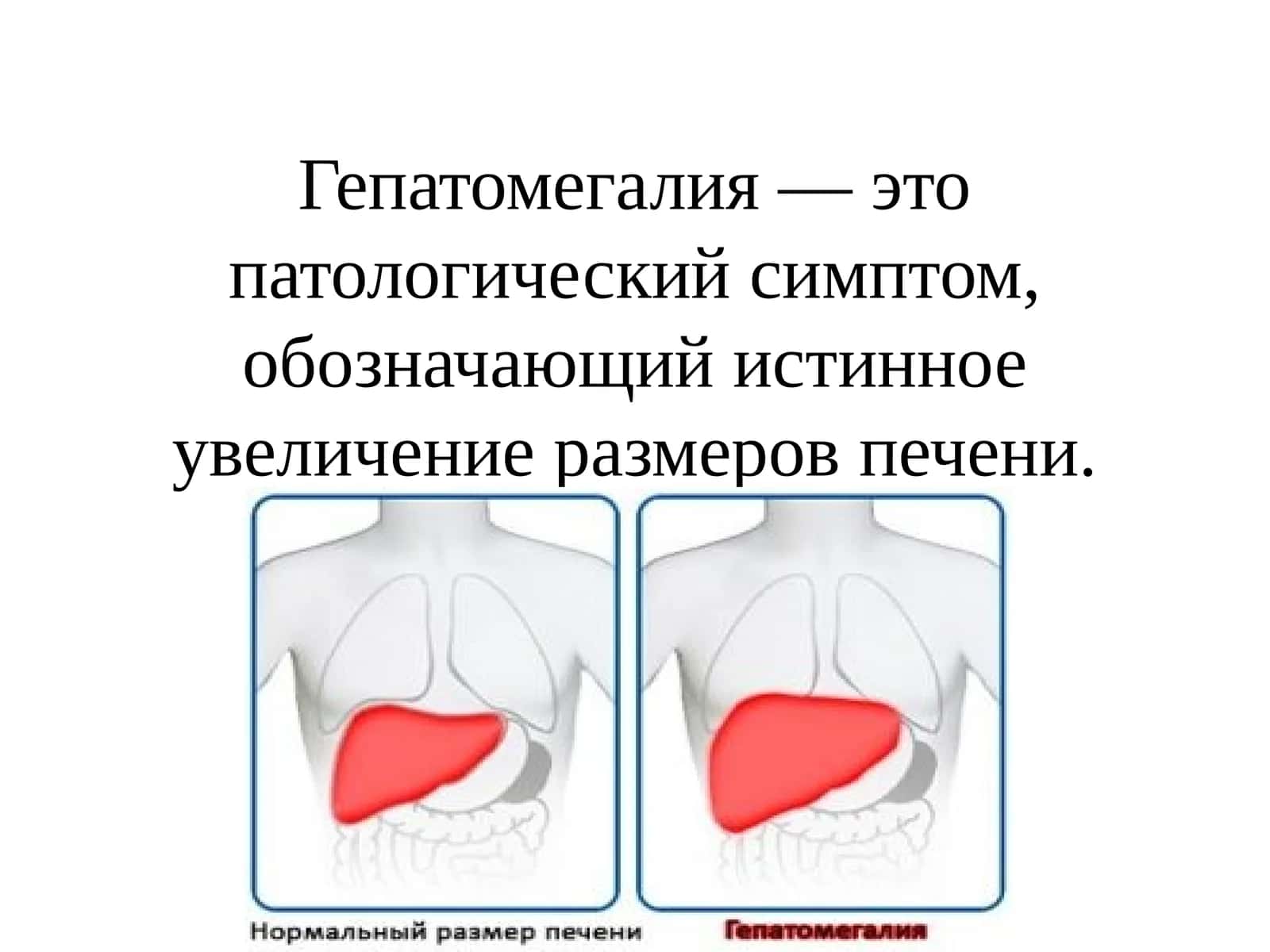 Гепатомегалия — это патологический симптом, обозначающий истинное увеличение размеров печени.