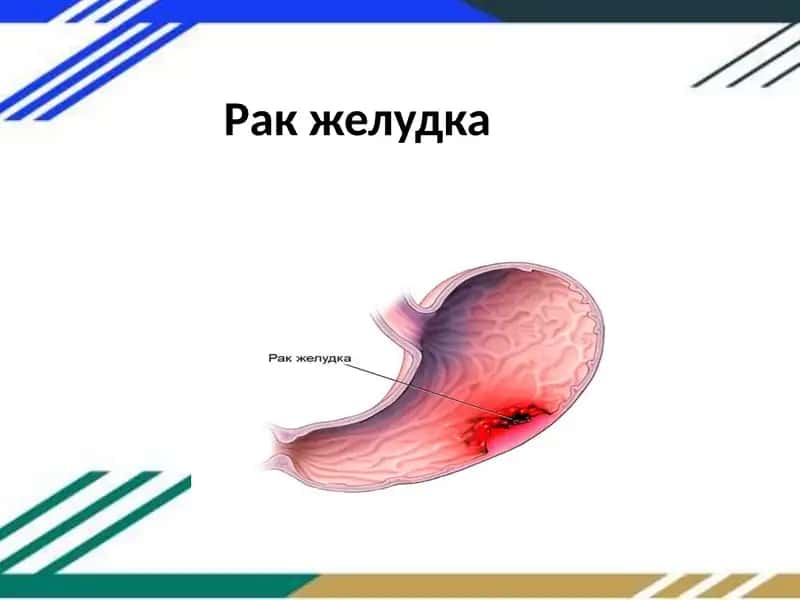 Рак желудка