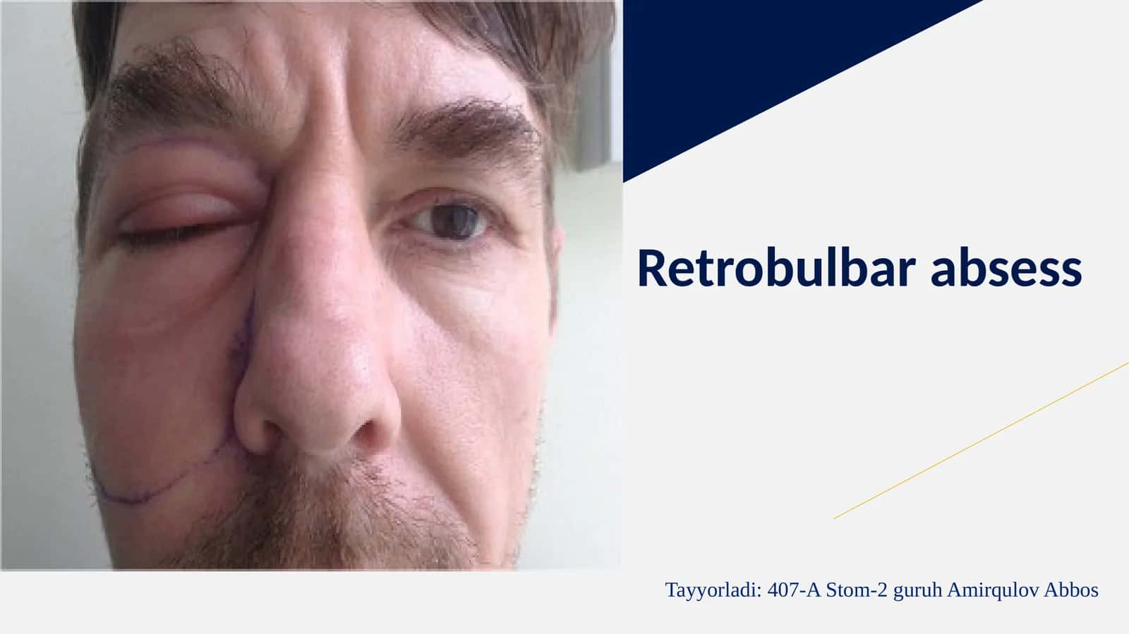 Retrobulbarabsess
