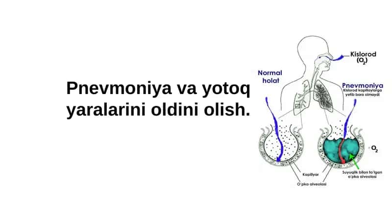 Pnevmoniya va yotoq yaralarini oldiniolish