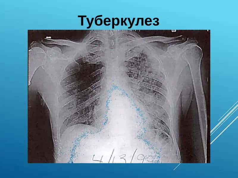 Туберкулез