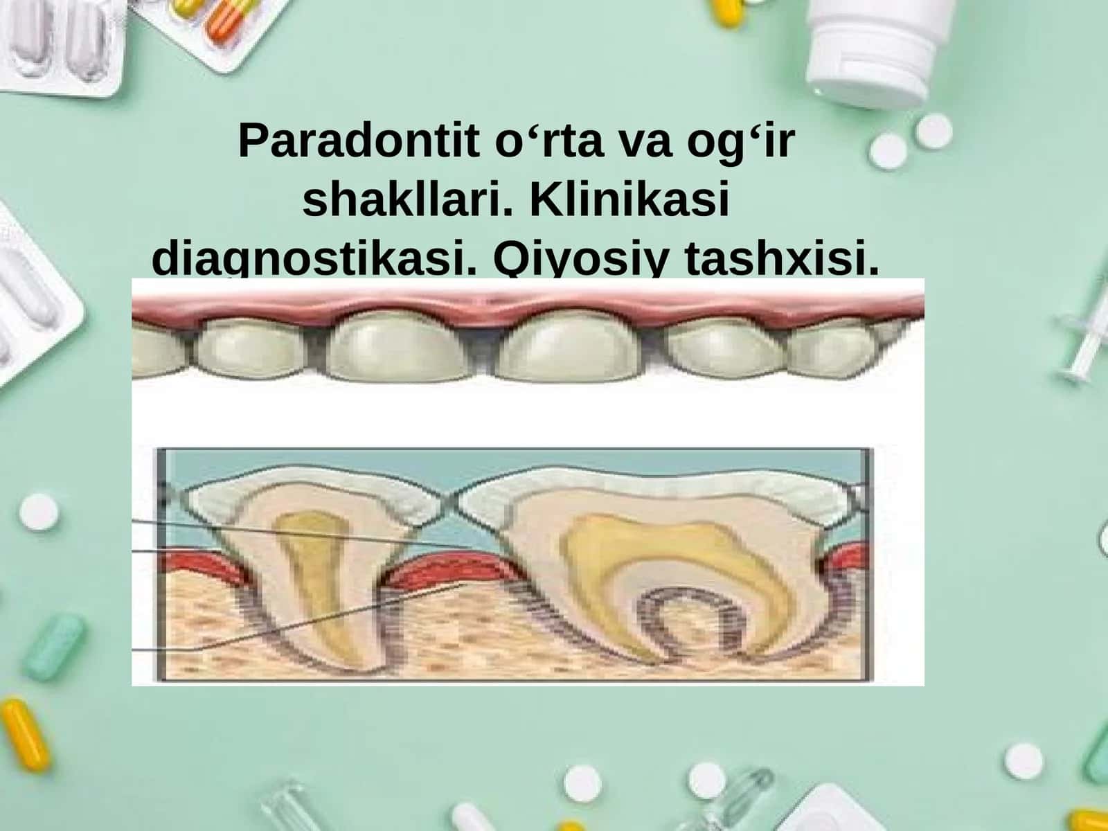 Paradontit