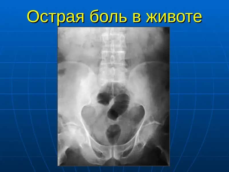 Острая боль в животе