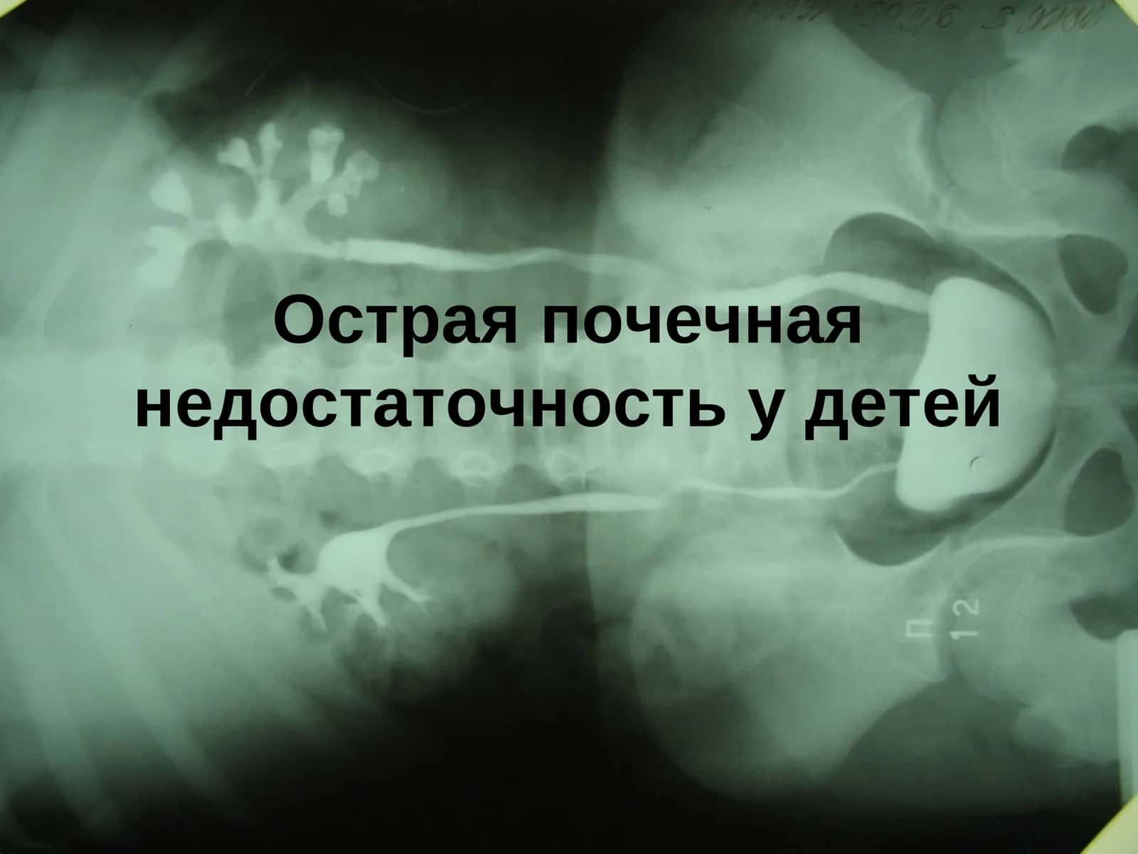 Острая почечная недостаточность у детей