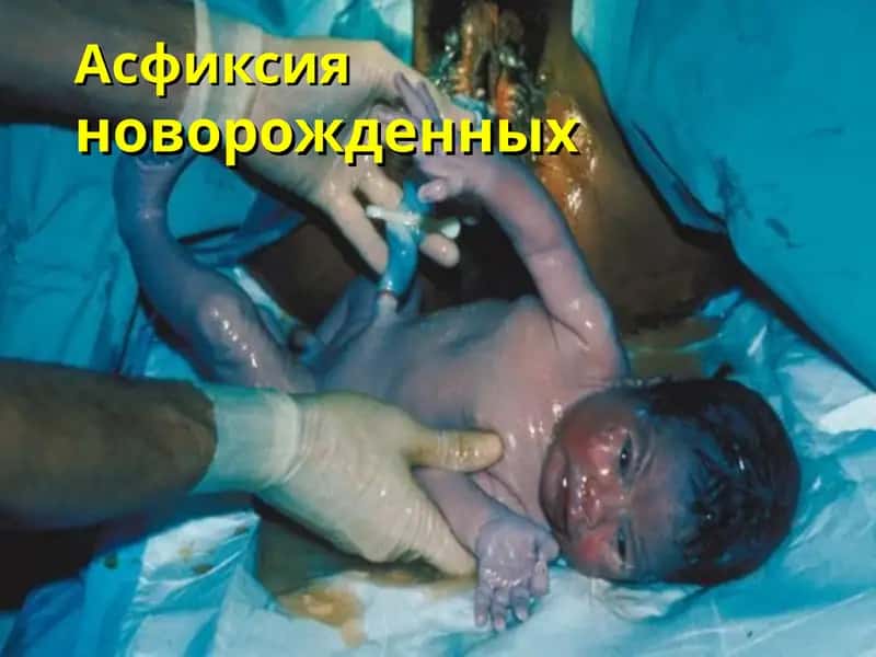 Асфиксия новорожденных