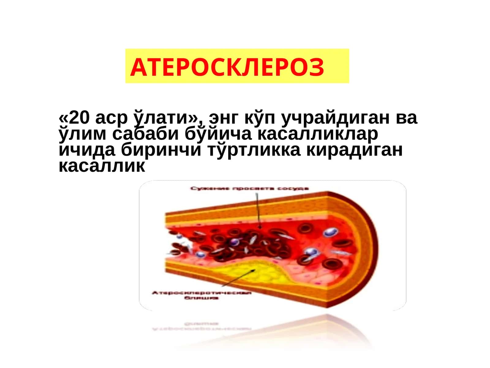 Атеросклероз