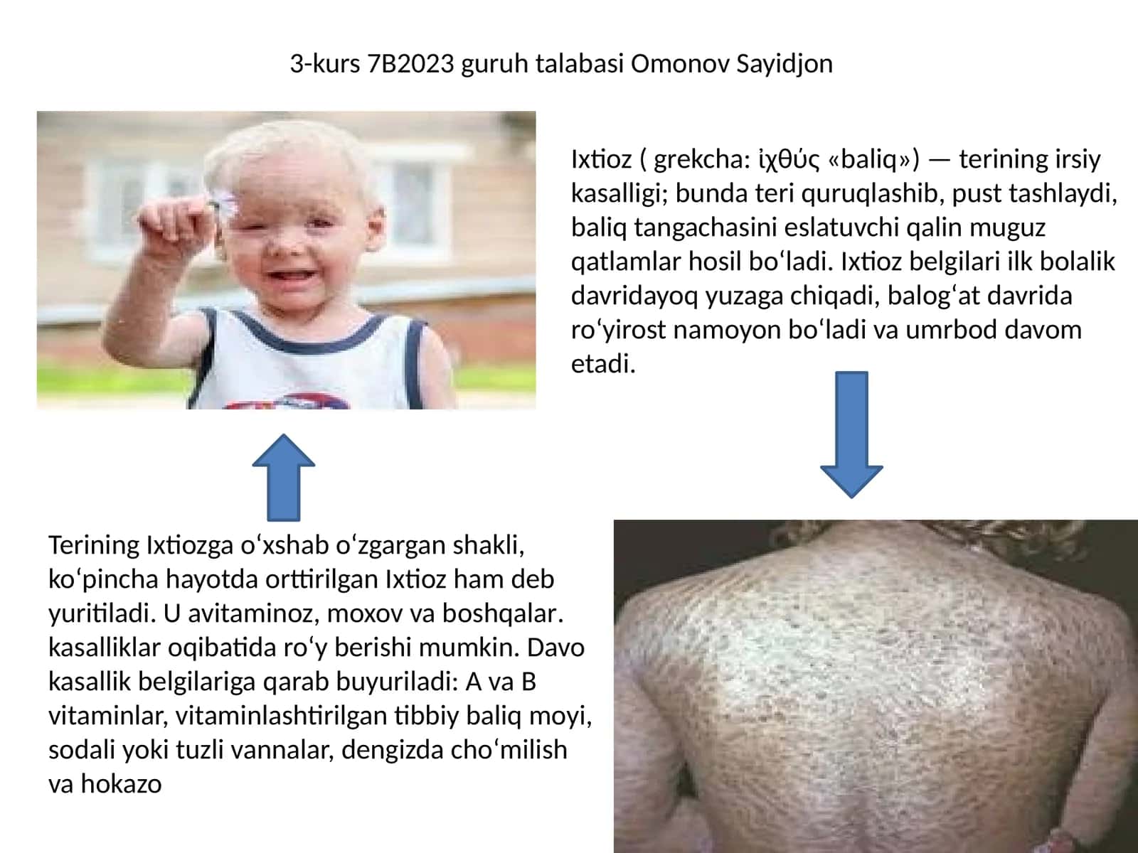 Ixtioz va gipertirixoz