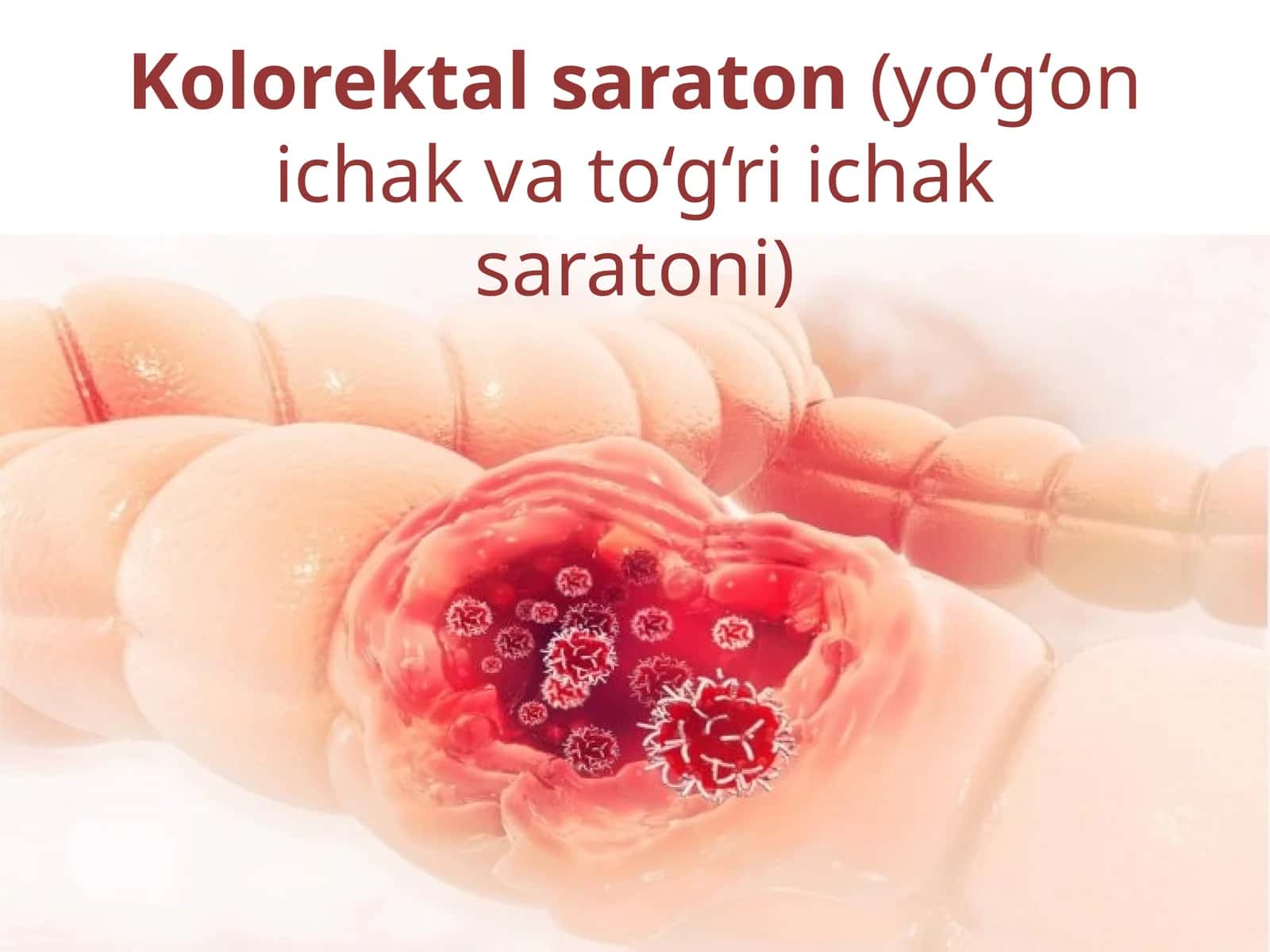 Kolorektal saraton(yo‘g‘on ichak va to‘g‘ri ichak saratoni)