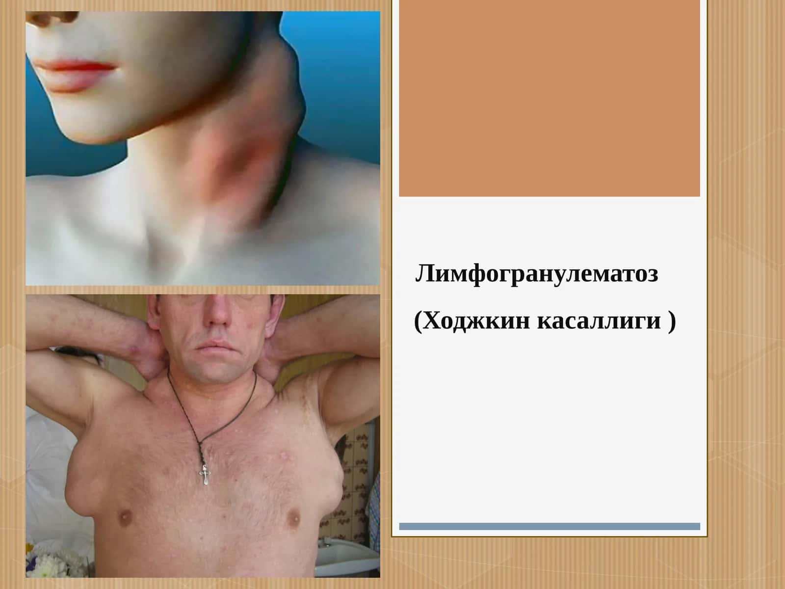 Лимфогранулематоз (Ходжкин касаллиги )