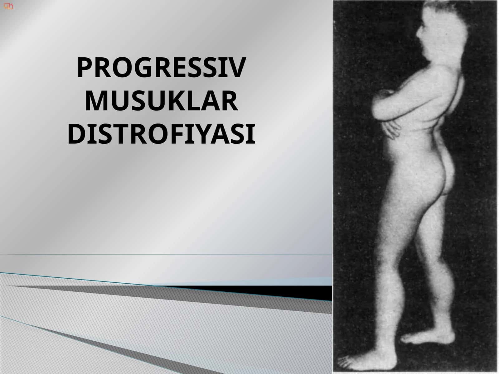 PROGRESSIV MUSUKLAR DISTROFIYASI