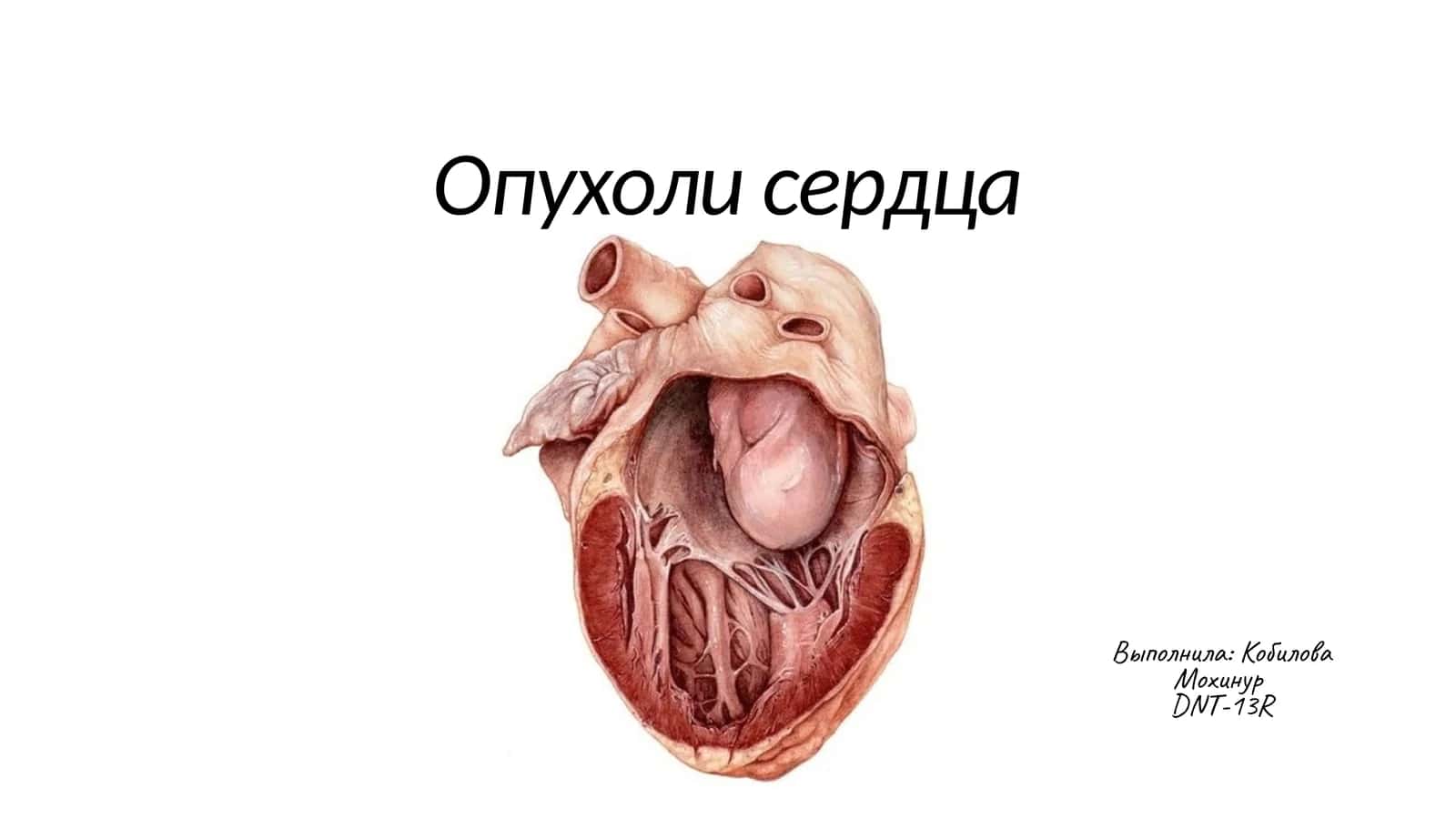 Опухоли сердца