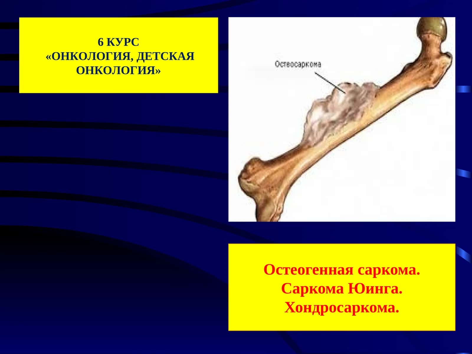 Остеогенная саркома, Саркома Юинга, Хондросаркома: Эпидемиология