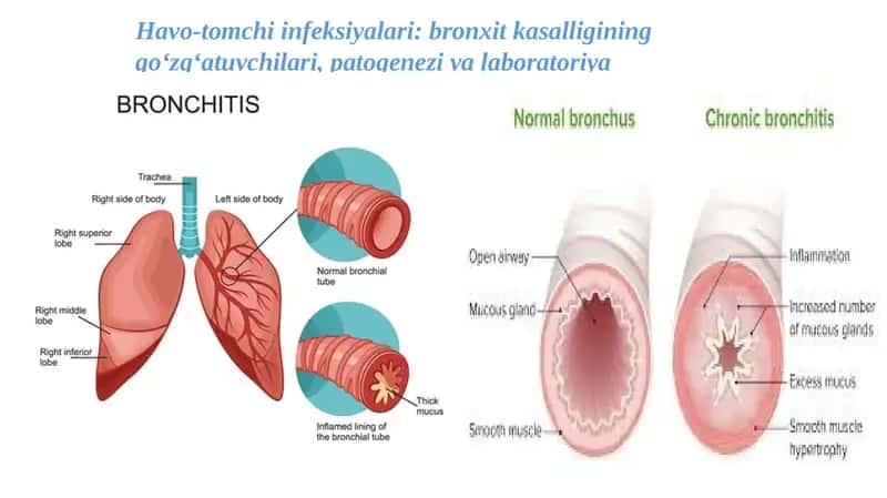Havo-tomchi infeksiyalari: bronxit kasalligining qo‘zg‘atuvchilari, patogenezi va laboratoriya tashhisi