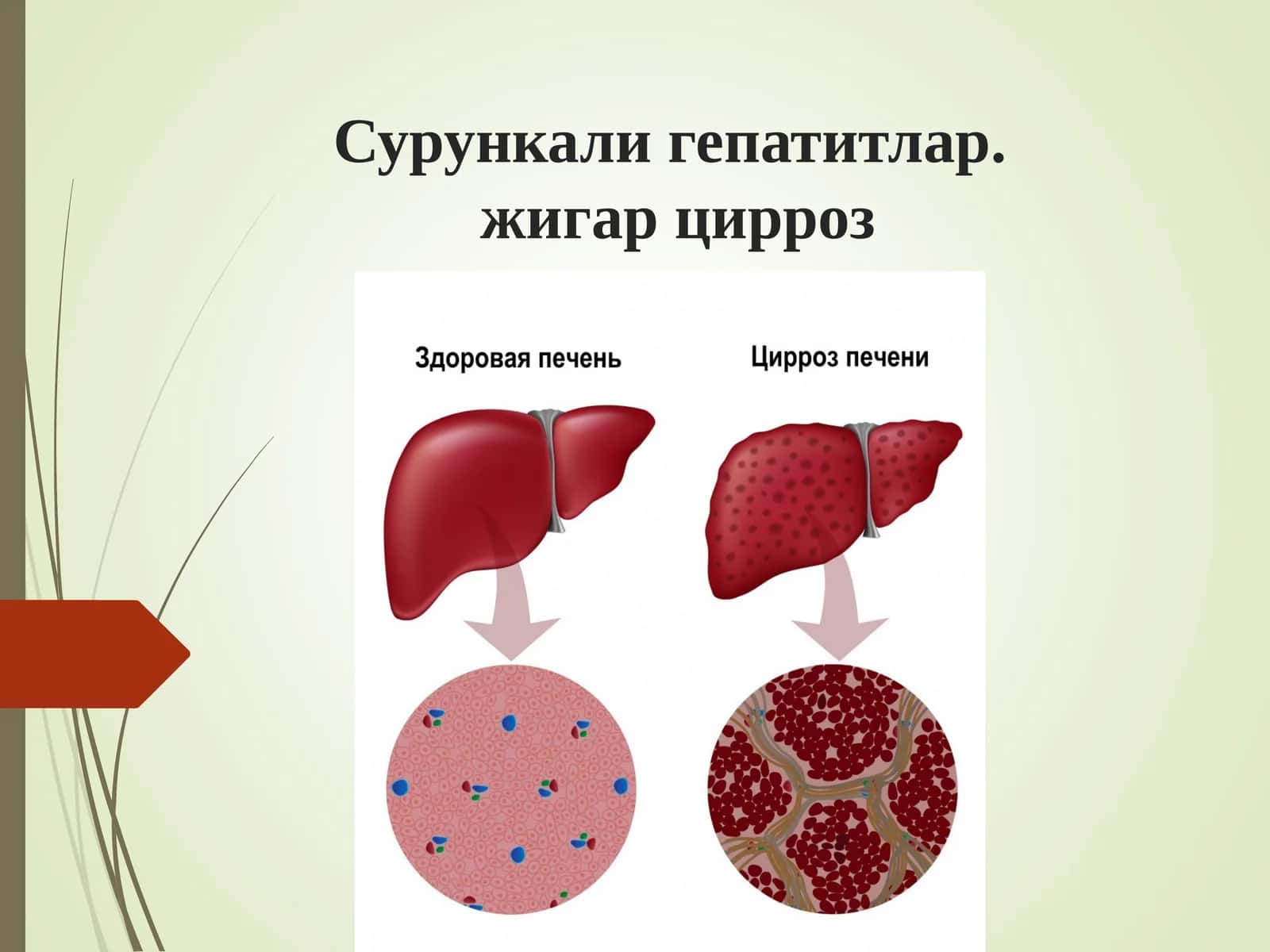 Сурункали гепатитлар. Жигар циррози