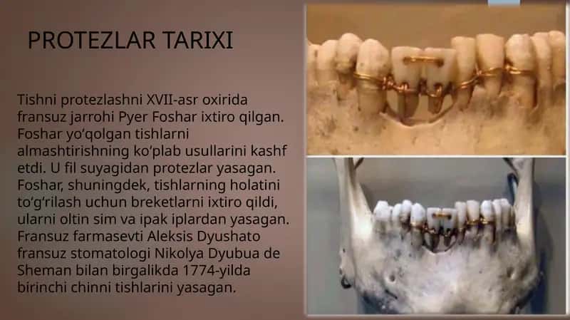 Ortopedik stomatologiyada protez turlari, protezlash