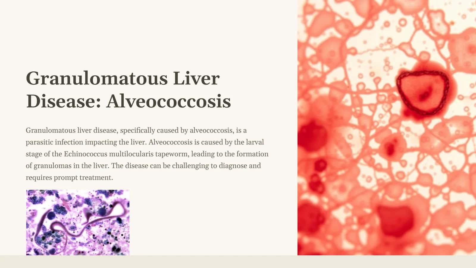 Granulomatous Liver Disease: Alveococcosis