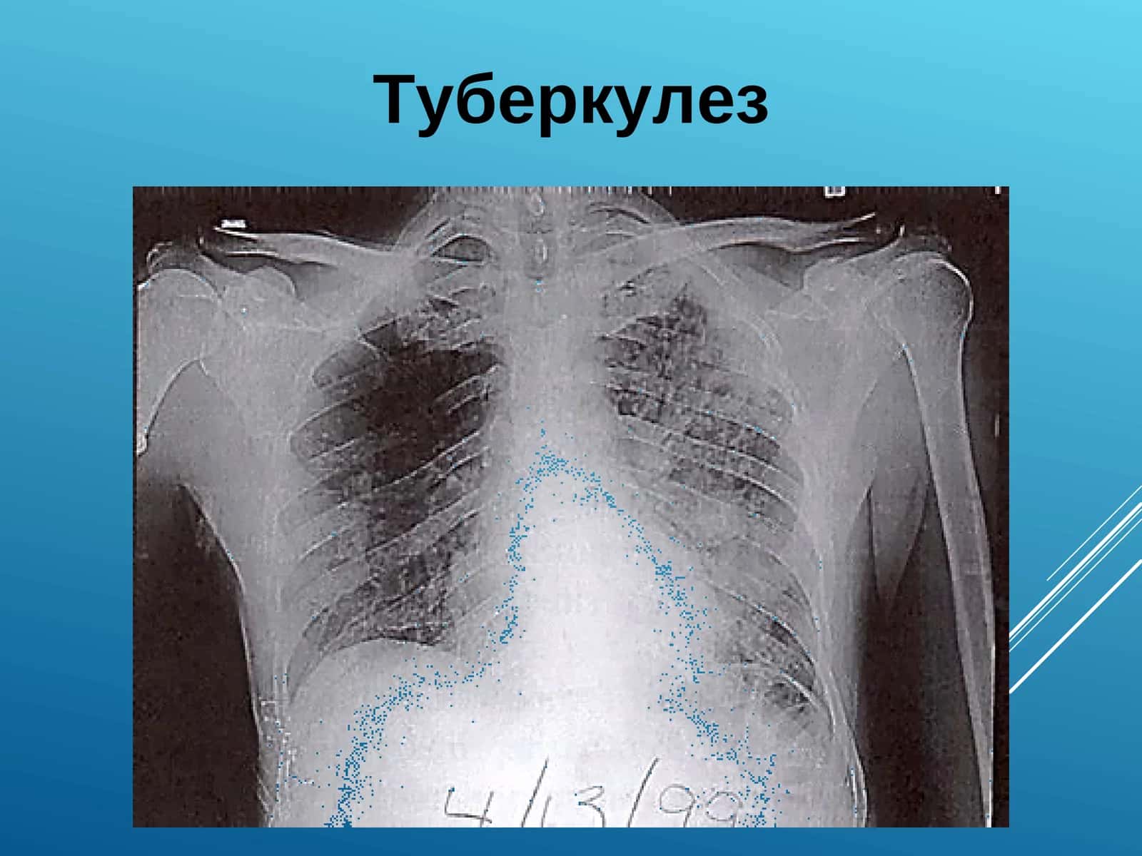 Tuberkulyoz. Tubrkulyoz