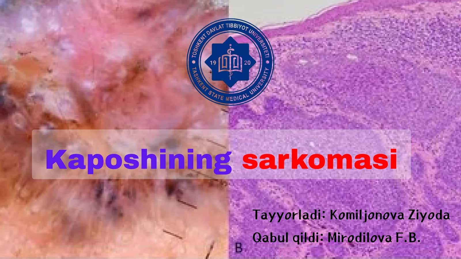 Kaposhining sarkomasi