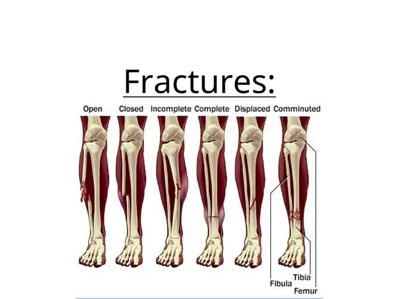 Fractures