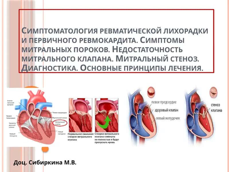 ОСТРАЯ РЕВМАТИЧЕСКАЯ ЛИХОРАДКА, ОПРЕДЕЛЕНИЕ