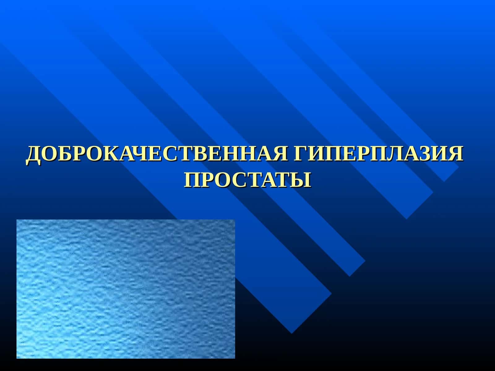 ДОБРОКАЧЕСТВЕННАЯ ГИПЕРПЛАЗИЯ ПРОСТАТЫ