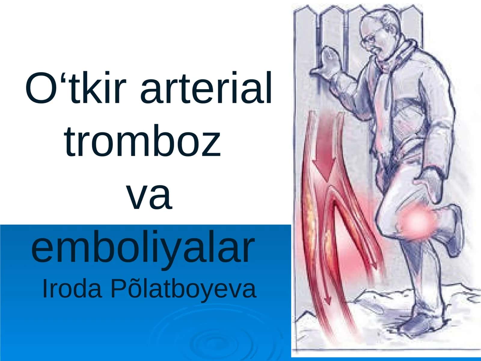 O‘tkir arterial trombozva emboliyalarIrodaPõlatboyeva