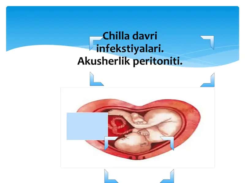 Chilla davri infekstiyalari. Akusherlik peritoniti.
