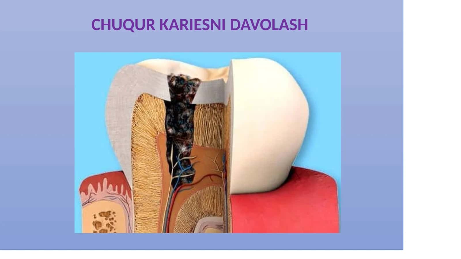 CHUQUR KARIESNI DAVOLASH