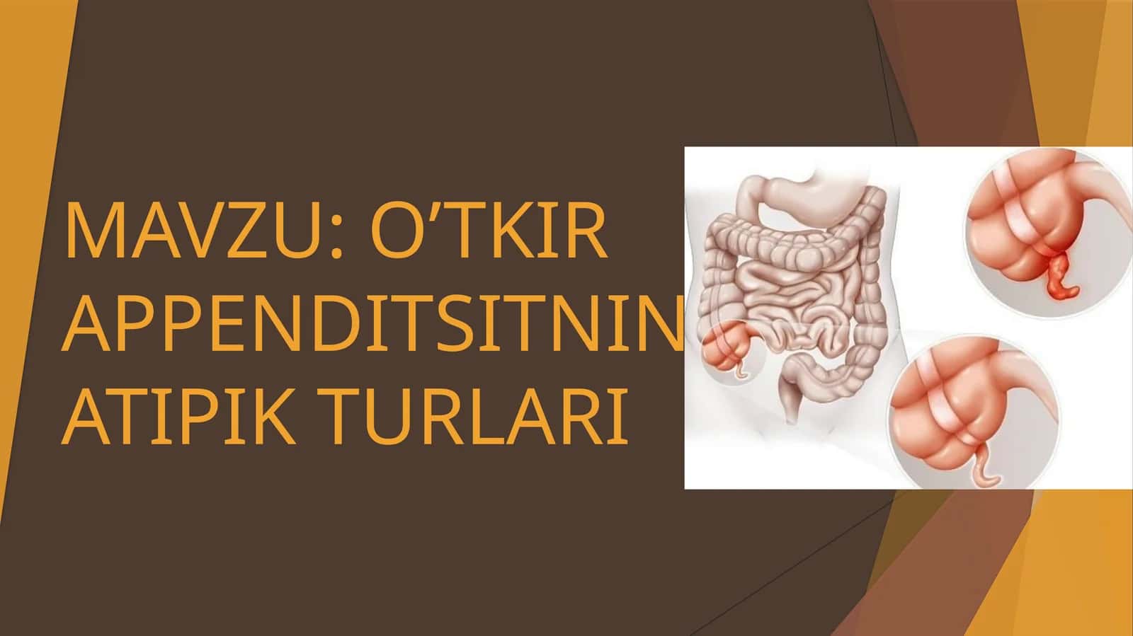 O’TKIR APPENDITSITNING ATIPIK TURLARI