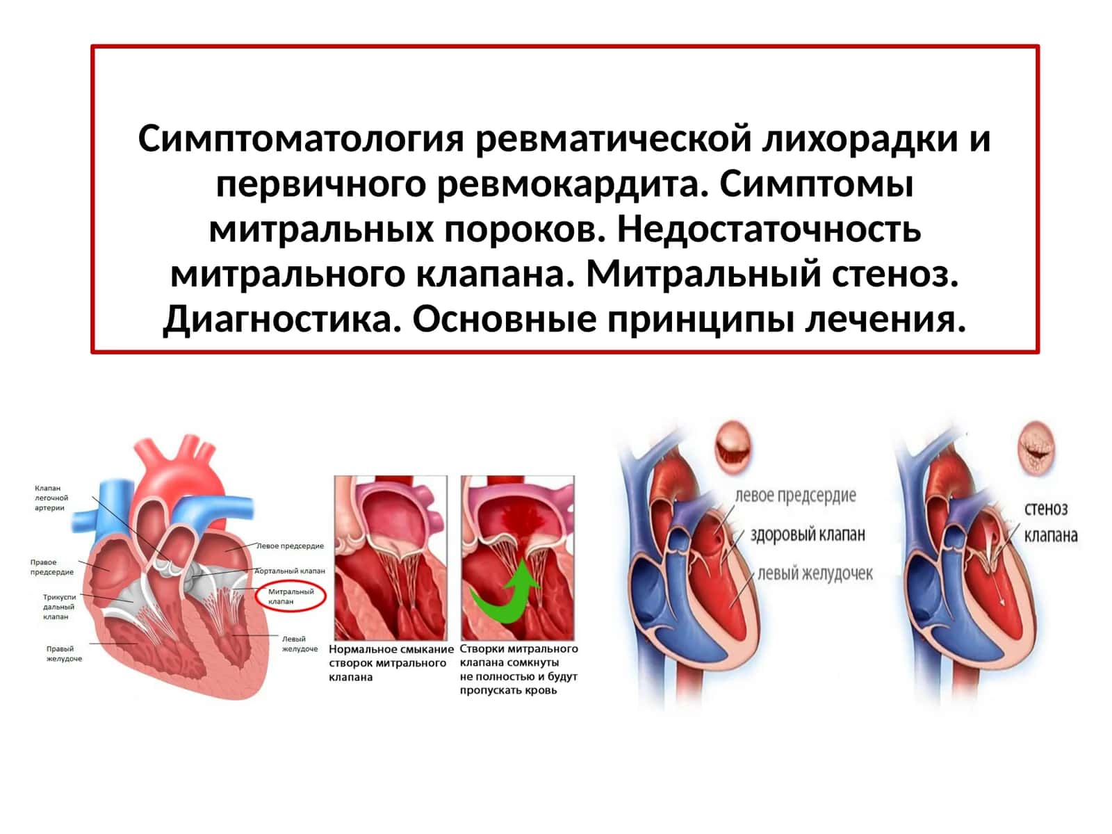 Острая ревматическая лихорадка, определение