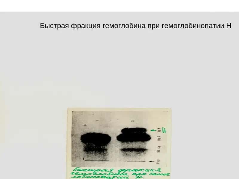 Генеологическая схема семьи с наследственной гемолитической анемией –β-талассемией