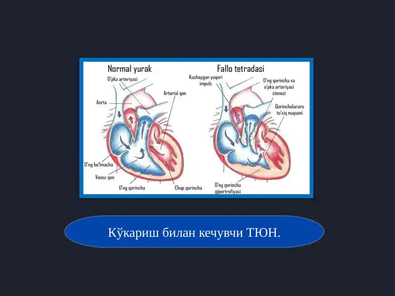 ТЮН (тўлиқ магистрал қон томирлар транспозицияси)