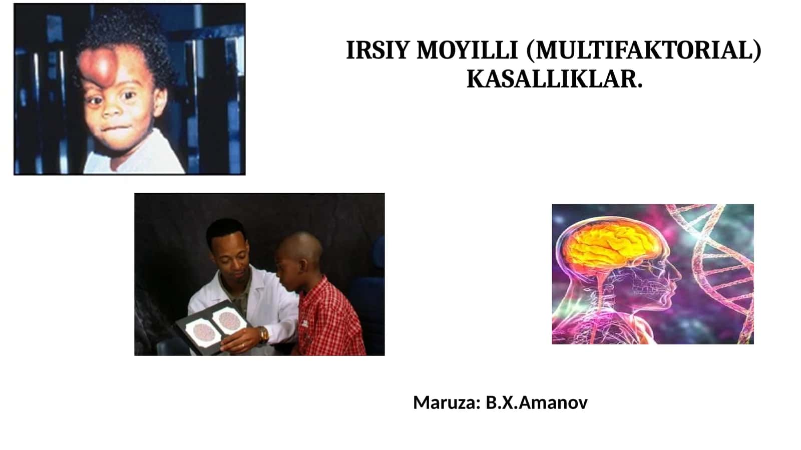 IRSIY MOYILLI (MULTIFAKTORIAL) KASALLIKLAR