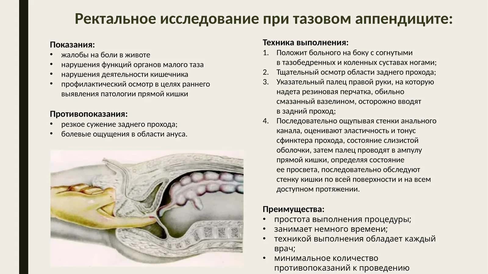 Ректальное исследование при тазовом аппендиците