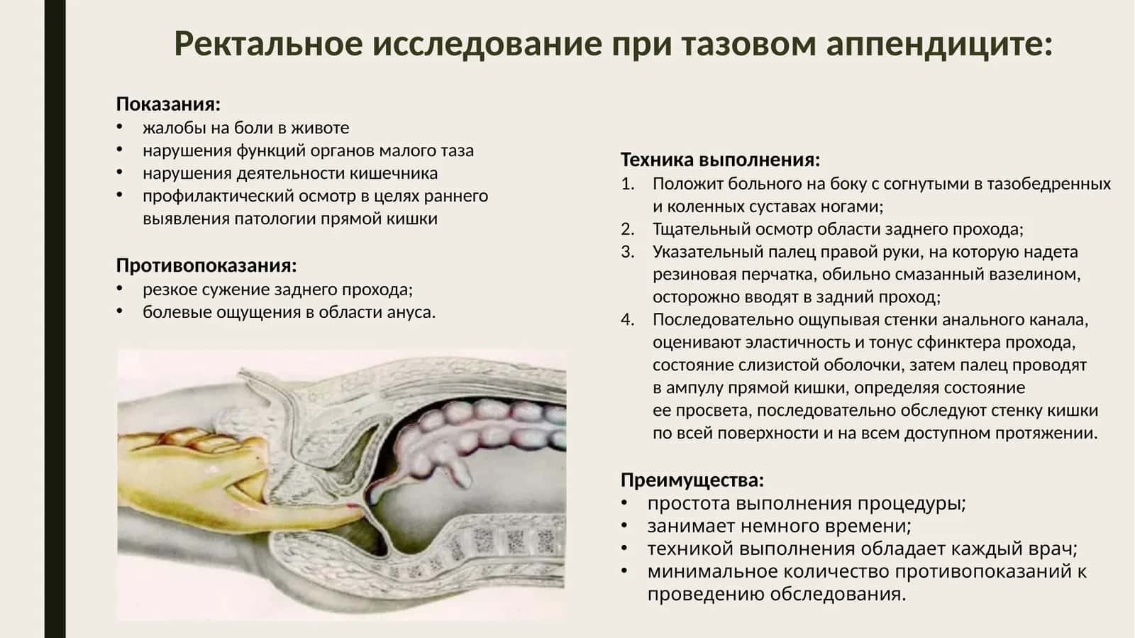 Ректальное исследование при тазовом аппендиците