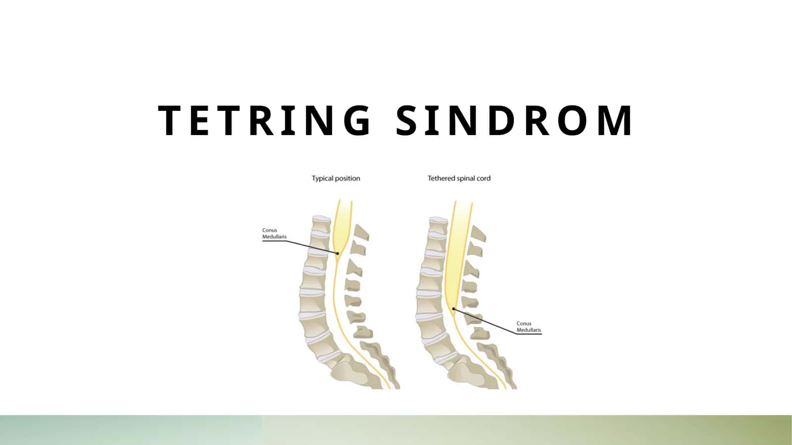 Tetring sindrom
