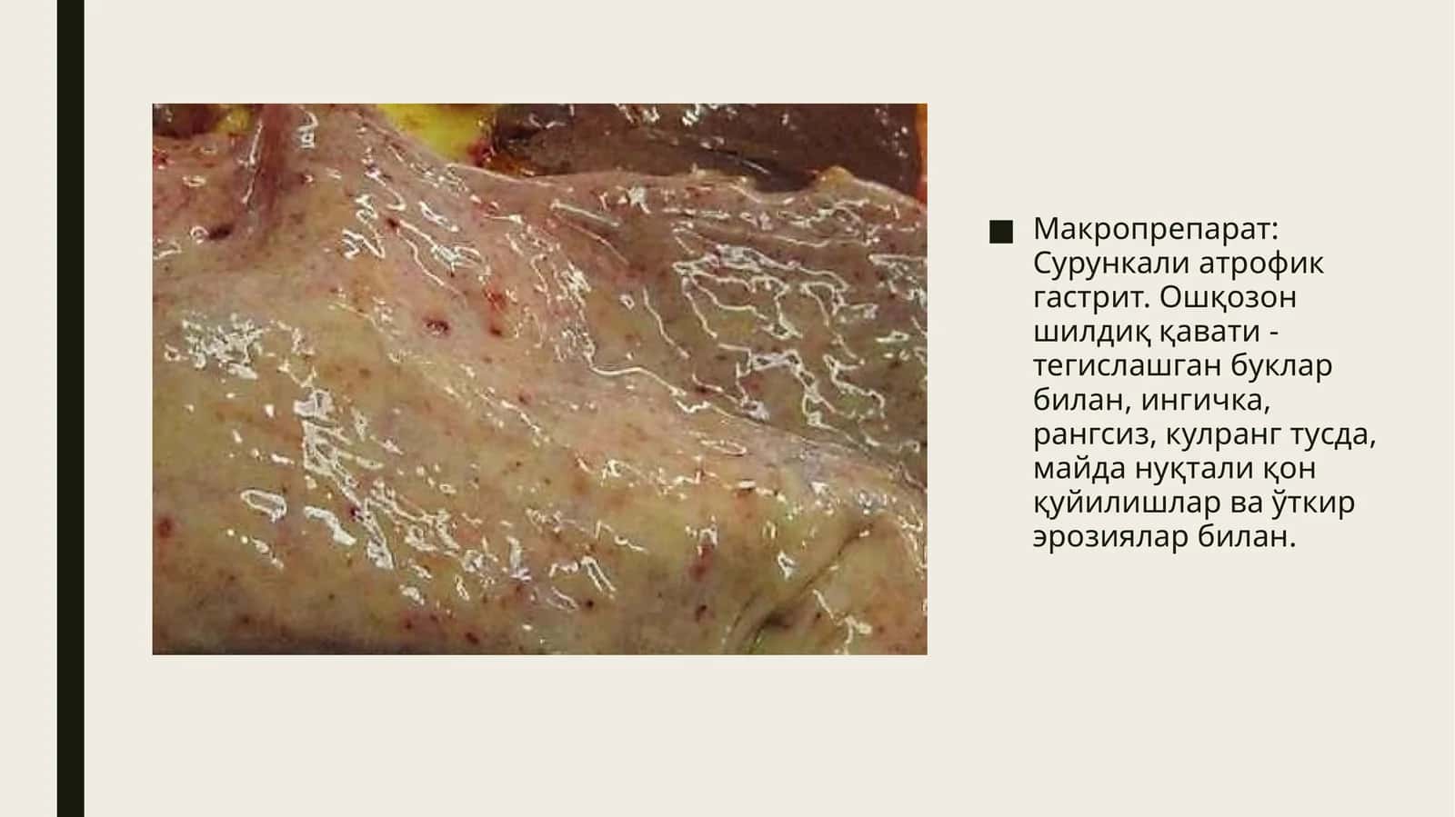 Макропрепарат: Сурункали атрофик гастрит. Микропрепарат: Буйрак амилоидози