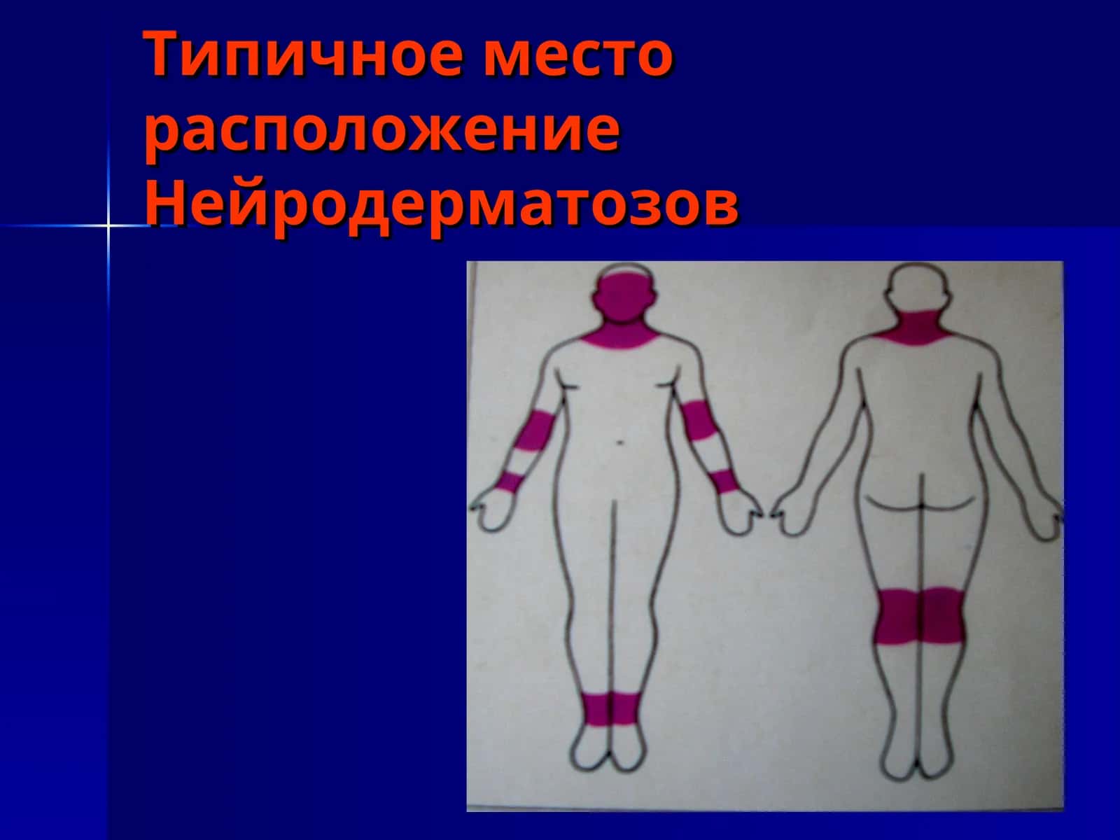 Типичное место расположение Нейродерматозов
