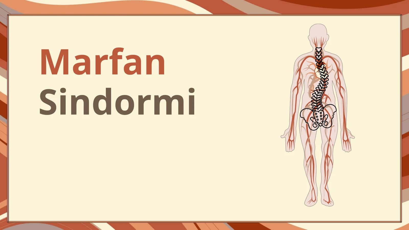 Marfan Sindromi