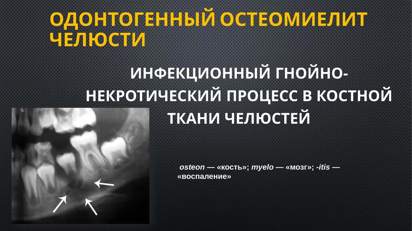 Одонтогенныйостеомиелитчелюсти