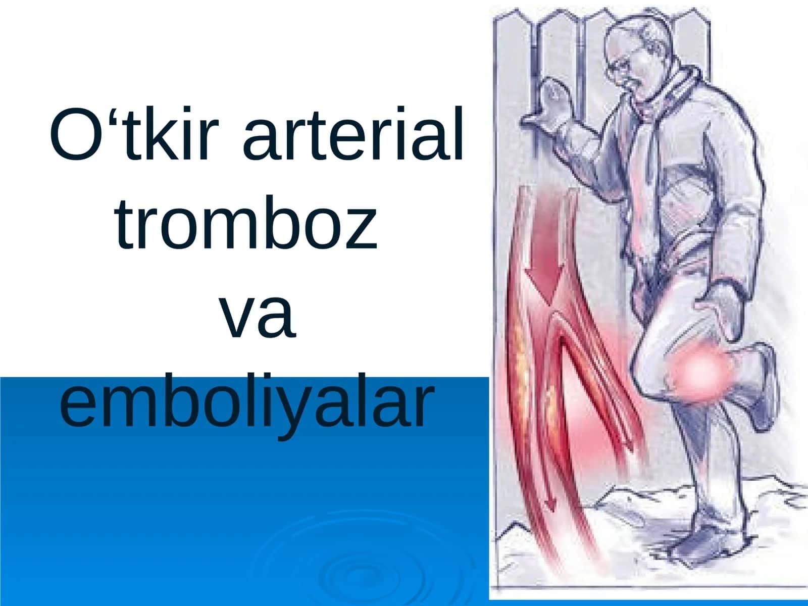 O‘tkir arterial trombozva emboliyalar