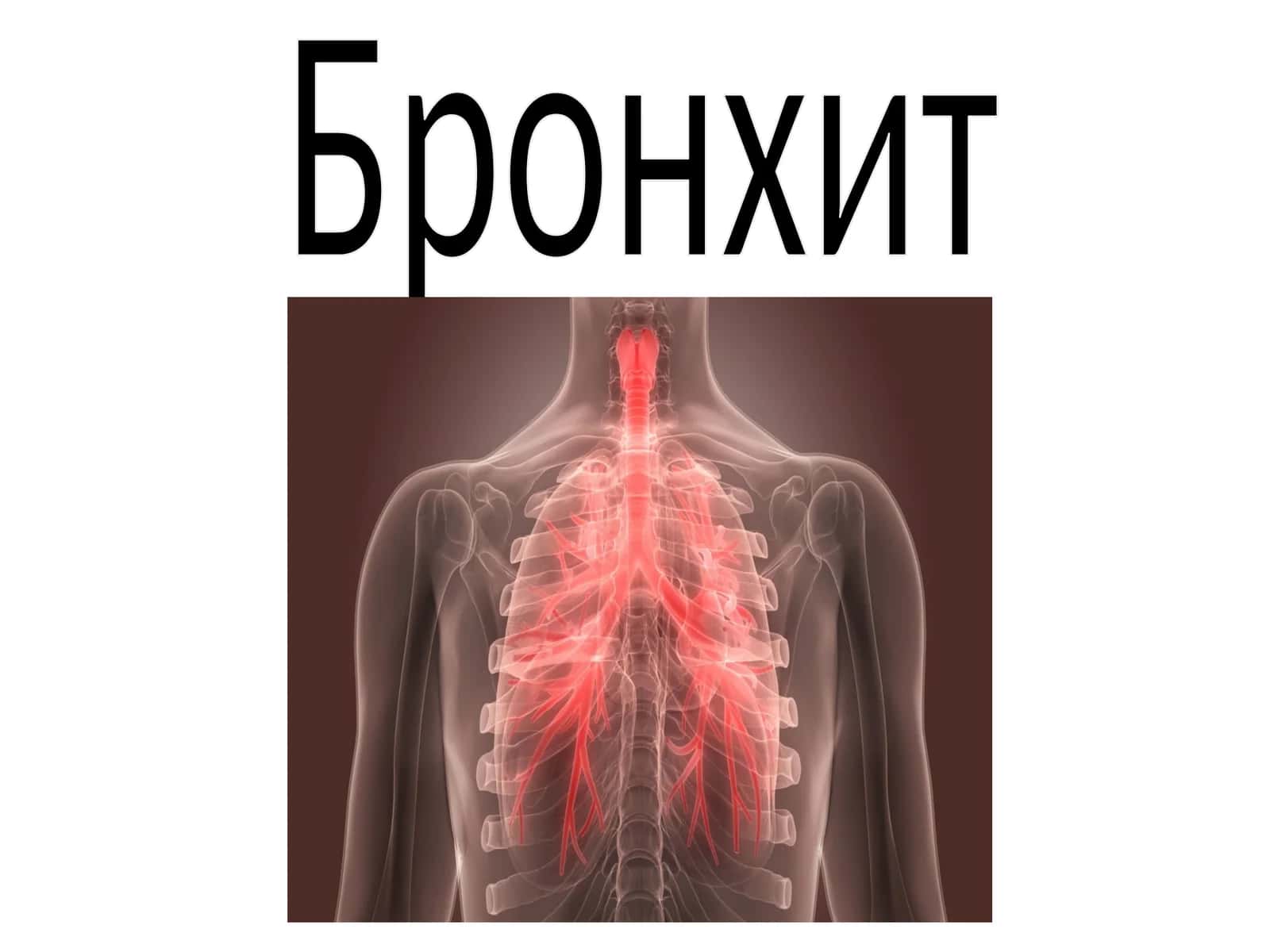 Острый бронхит