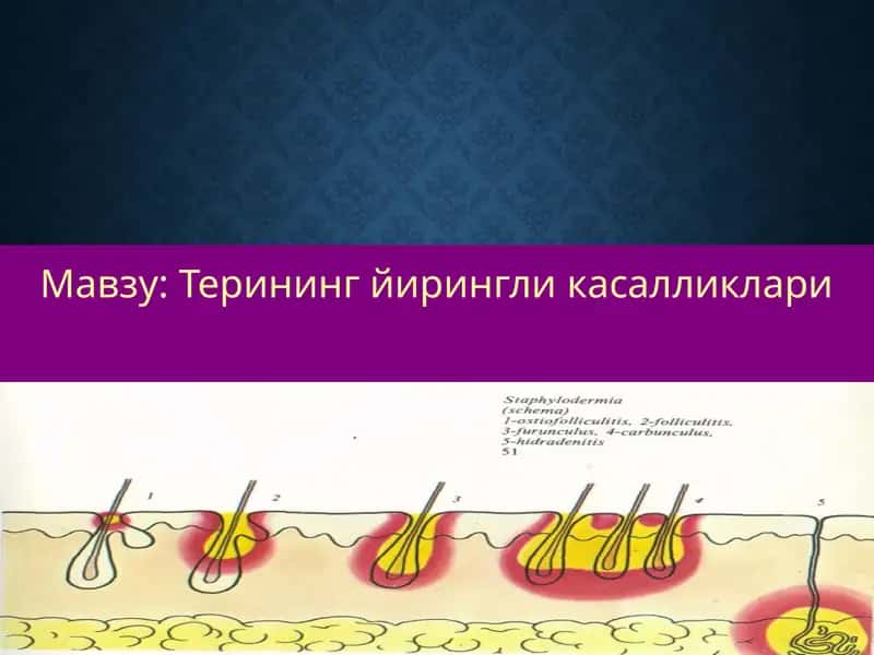 Терининг йирингли касалликлари