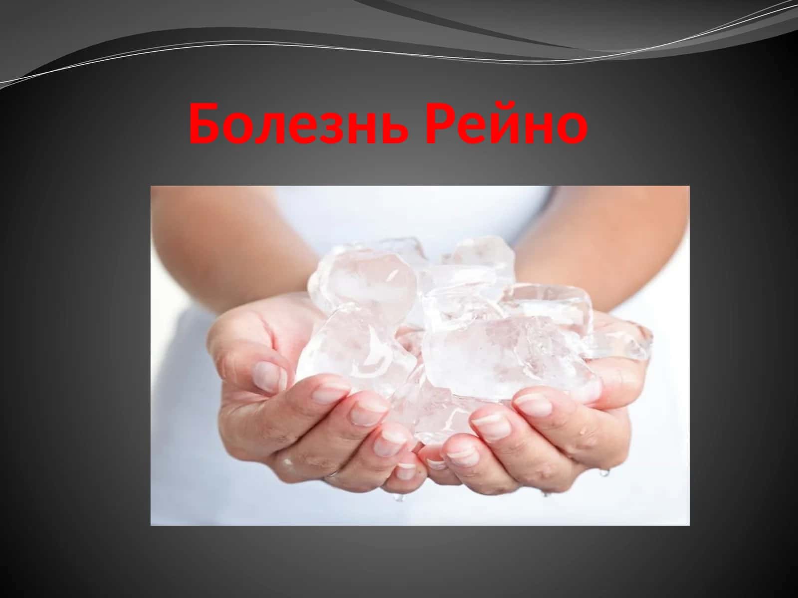 Болезнь Рейно