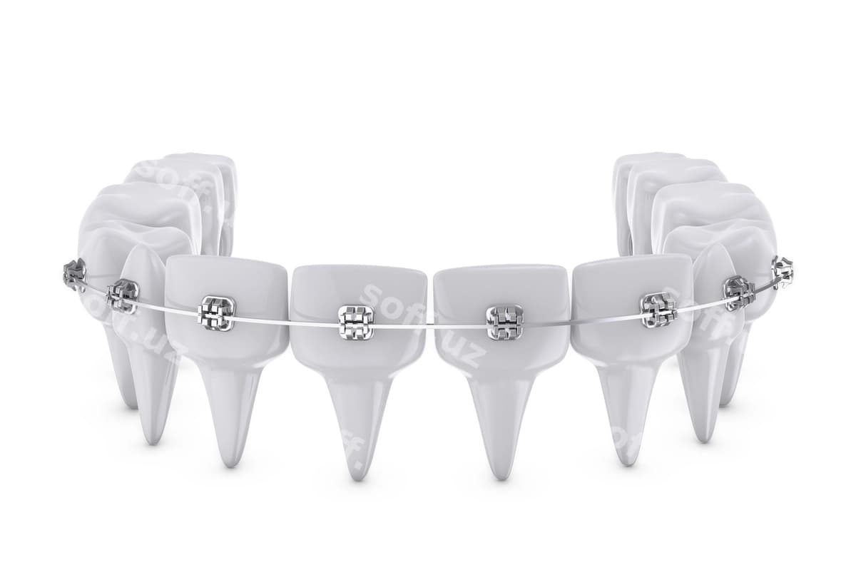 Tish qisqartmalari | Dental brackets