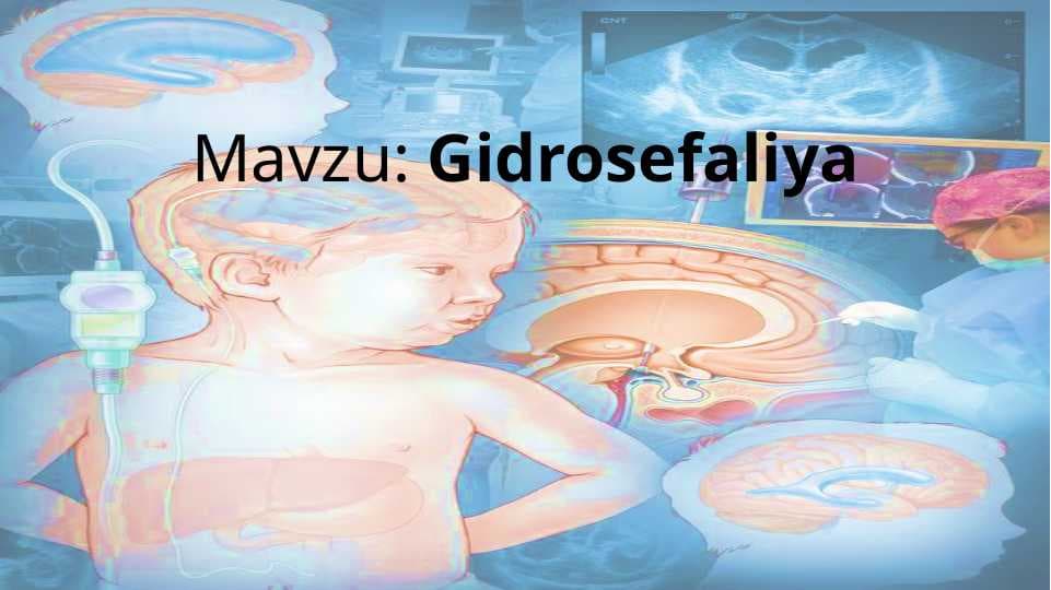 Gidrosefaliya