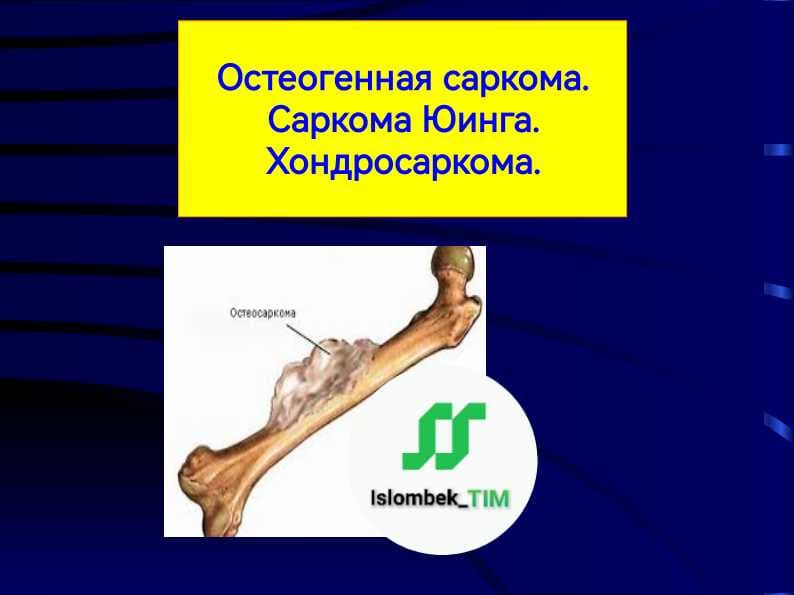 Остеогенная саркома. Саркома Юинга. Хондросаркома