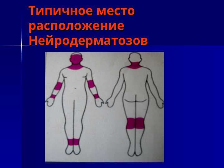 Типичное место расположение Нейродерматозов